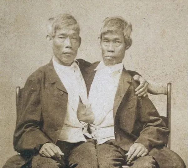 连体人结婚是怎样过日子,连体人如何娶妻生子