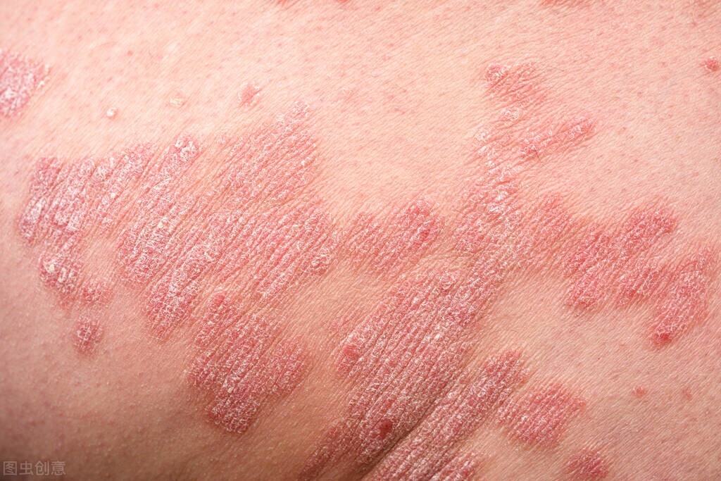 皮炎和癣有什么区别,癣和皮炎有什么区别