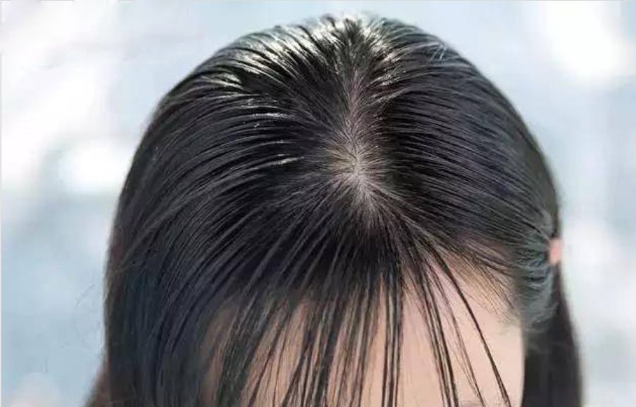 头皮屑太多怎么办最有效方法,头皮屑太多有什么妙招