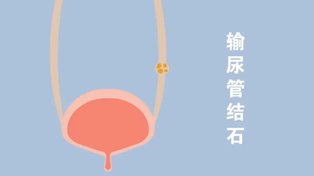 如何预防泌尿系统结石,对于泌尿系结石最有效的预防方法