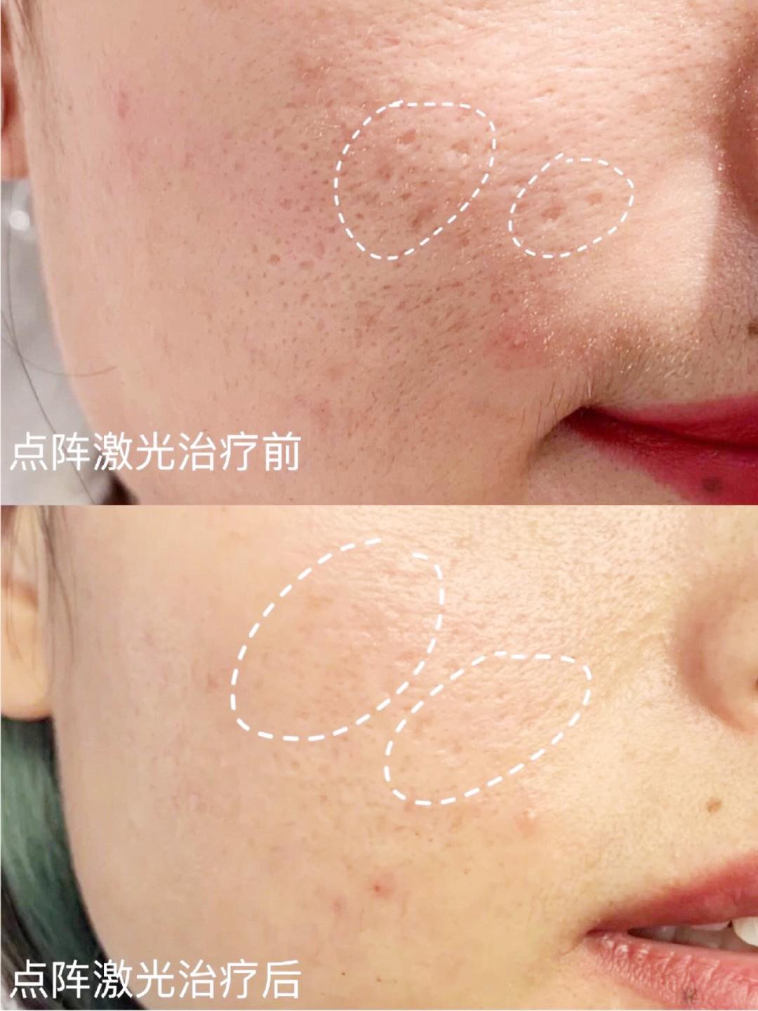 缩毛孔的有效方法,缩毛孔最靠谱的方法