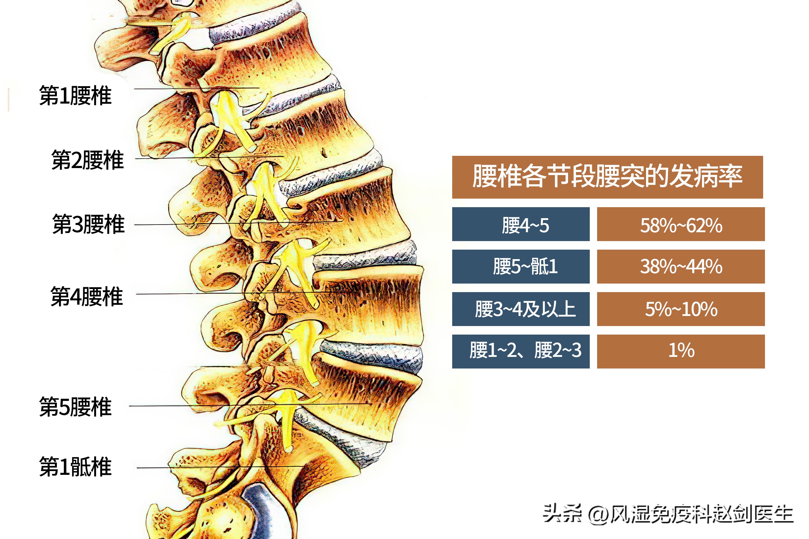 腰突马尾神经综合征发病率,坐骨神经跟马尾神经是一回事么