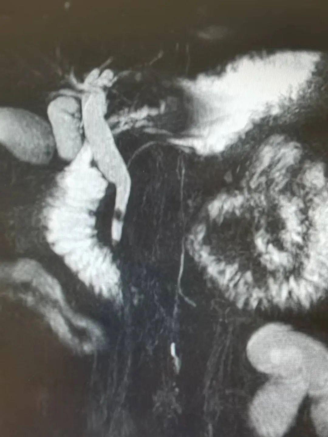 秦皇岛市第一医院普通外科一病区双镜联合经胆囊颈管取石技术日臻成熟