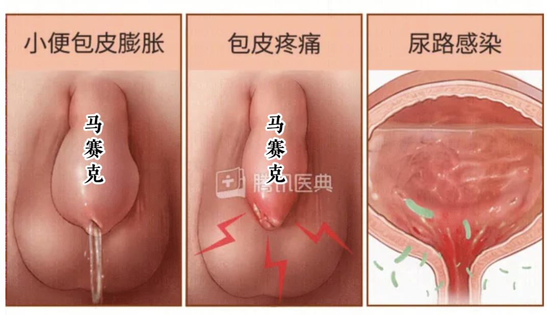 “妈妈再也不用担心我‘玩鸡鸡’！”深圳南山首家儿童包皮门诊开诊