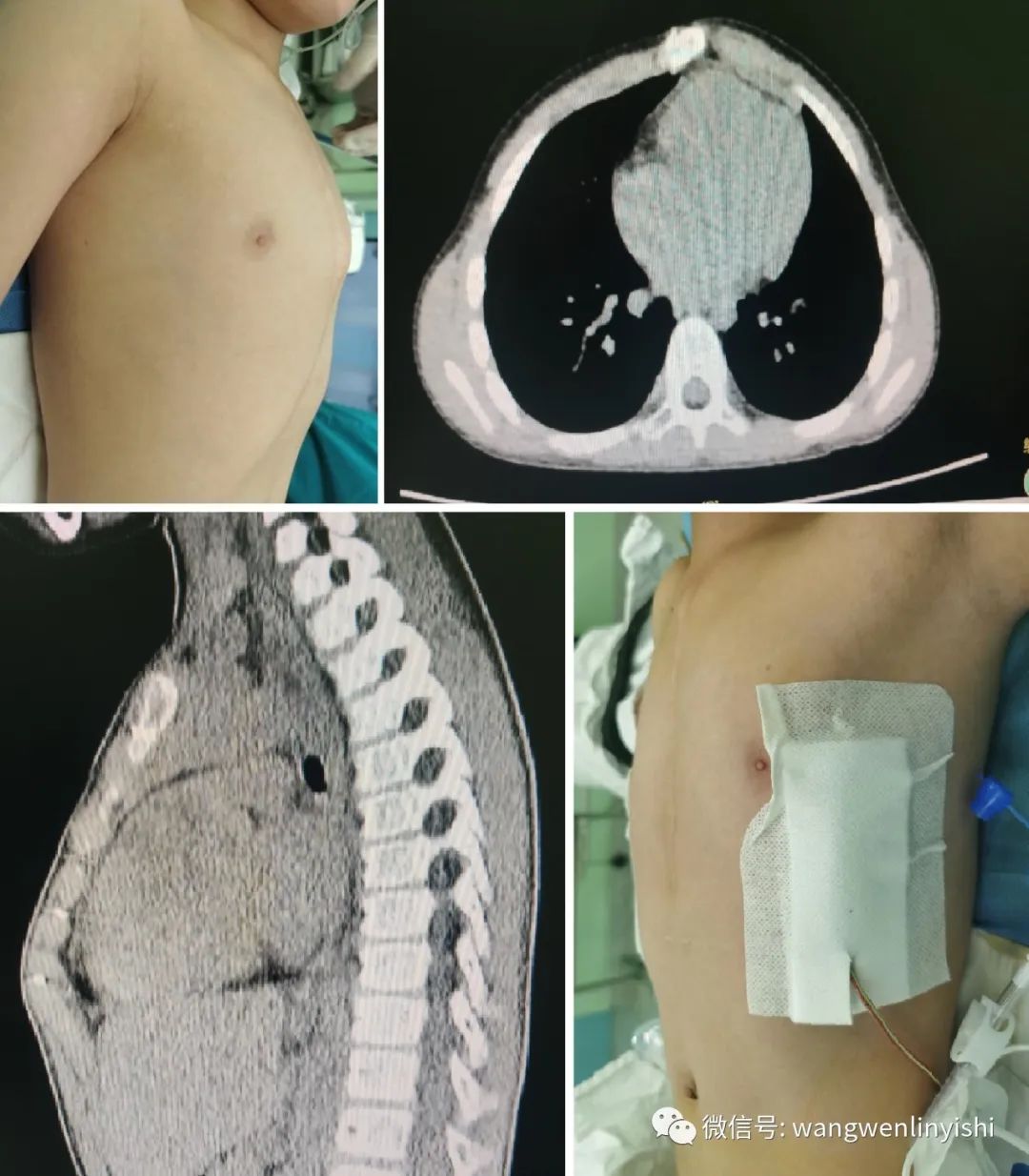 温岭手术多少钱,wenlin手术成功案例
