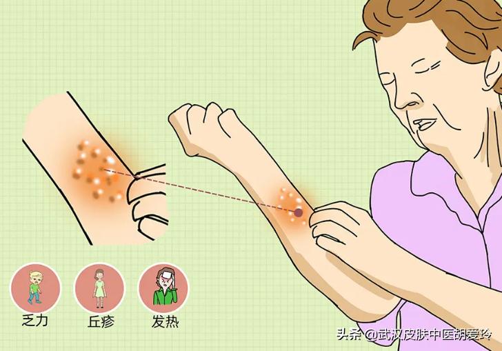 胳膊上长水泡并且疼痛难忍，这边的耳朵也有点嗡嗡作响