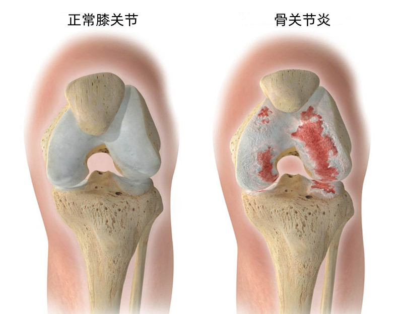 肩膀疼手腕肿怎么了,肩膀疼有一块淤青发紫