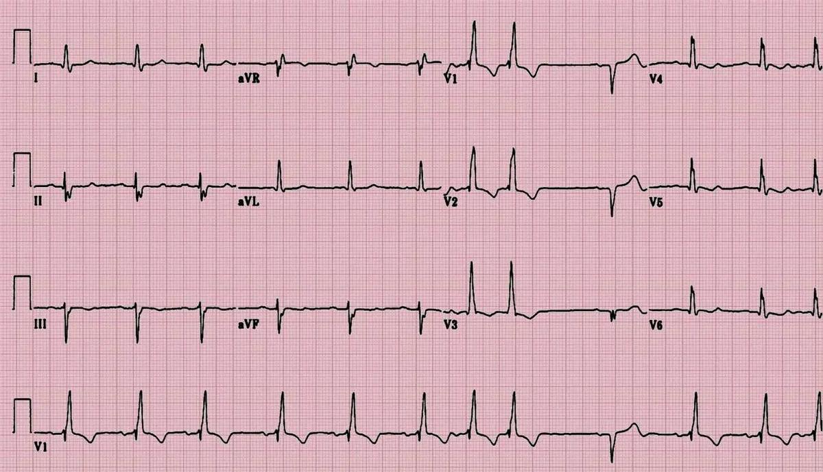 男子喝酒突发心脏病抢救,男子喝药酒突发心脏骤停