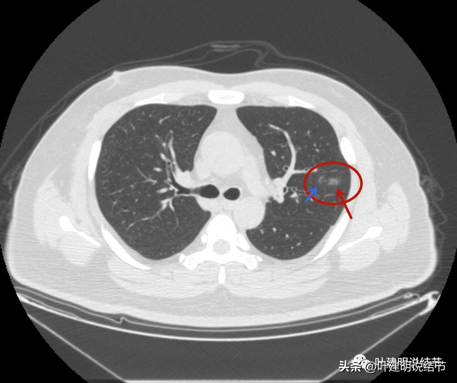 如何判断肺磨玻璃结节是高危结节,肺上有混合磨玻璃结节要注意什么