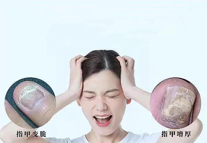 一文读懂帕金森病,深度解读灰指甲