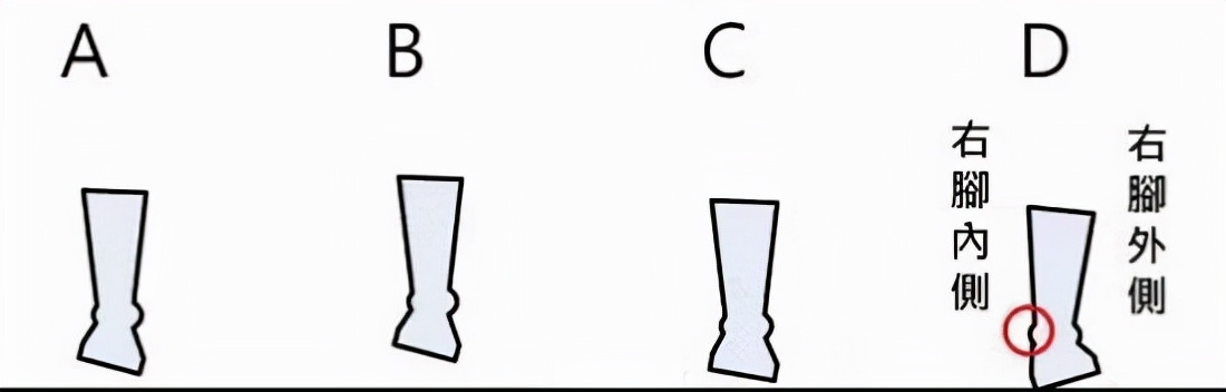 足内翻原因及治疗,足内翻足外翻怎么引起的