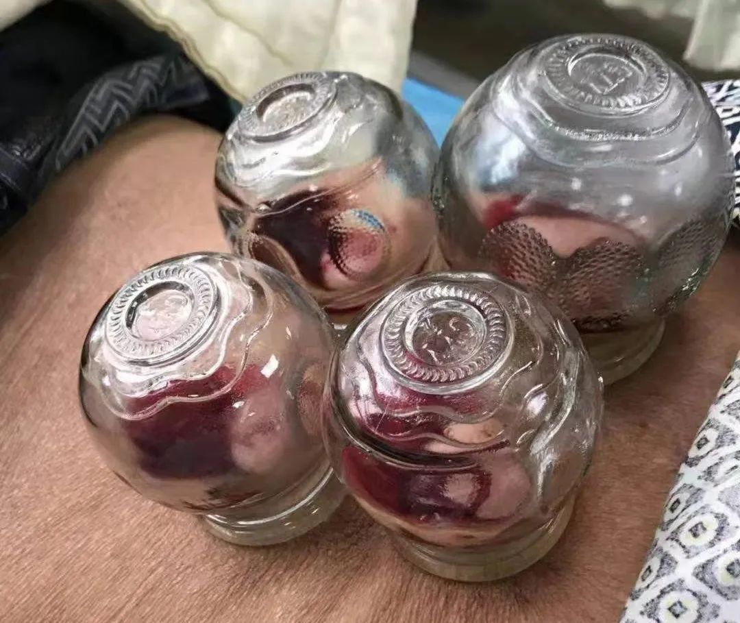 乳腺癌术后淋巴水肿的中医外治,乳腺癌术后游泳会引起淋巴水肿吗