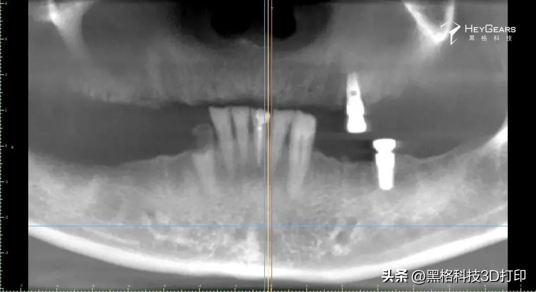 病例分享|美国BDG诊所实现全口即刻修复病例一则