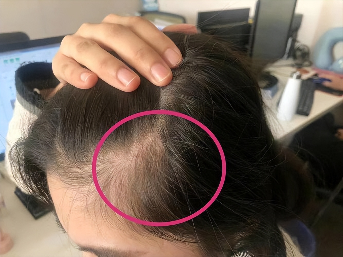 湖南校花坚持用硫磺皂洗头,用硫磺皂洗澡坚持了一年