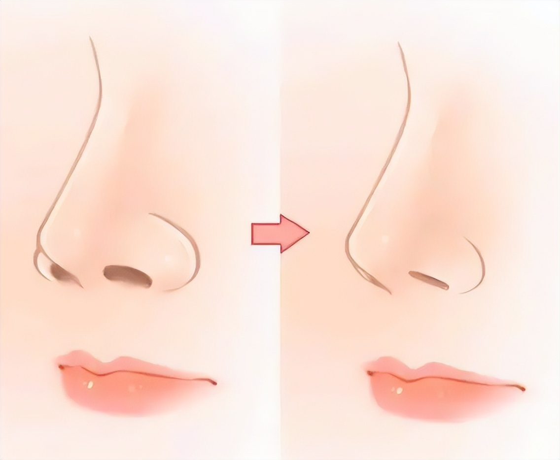 上海九院韦敏做的鼻子,上海九院韦敏和张盈帆隆鼻哪个好