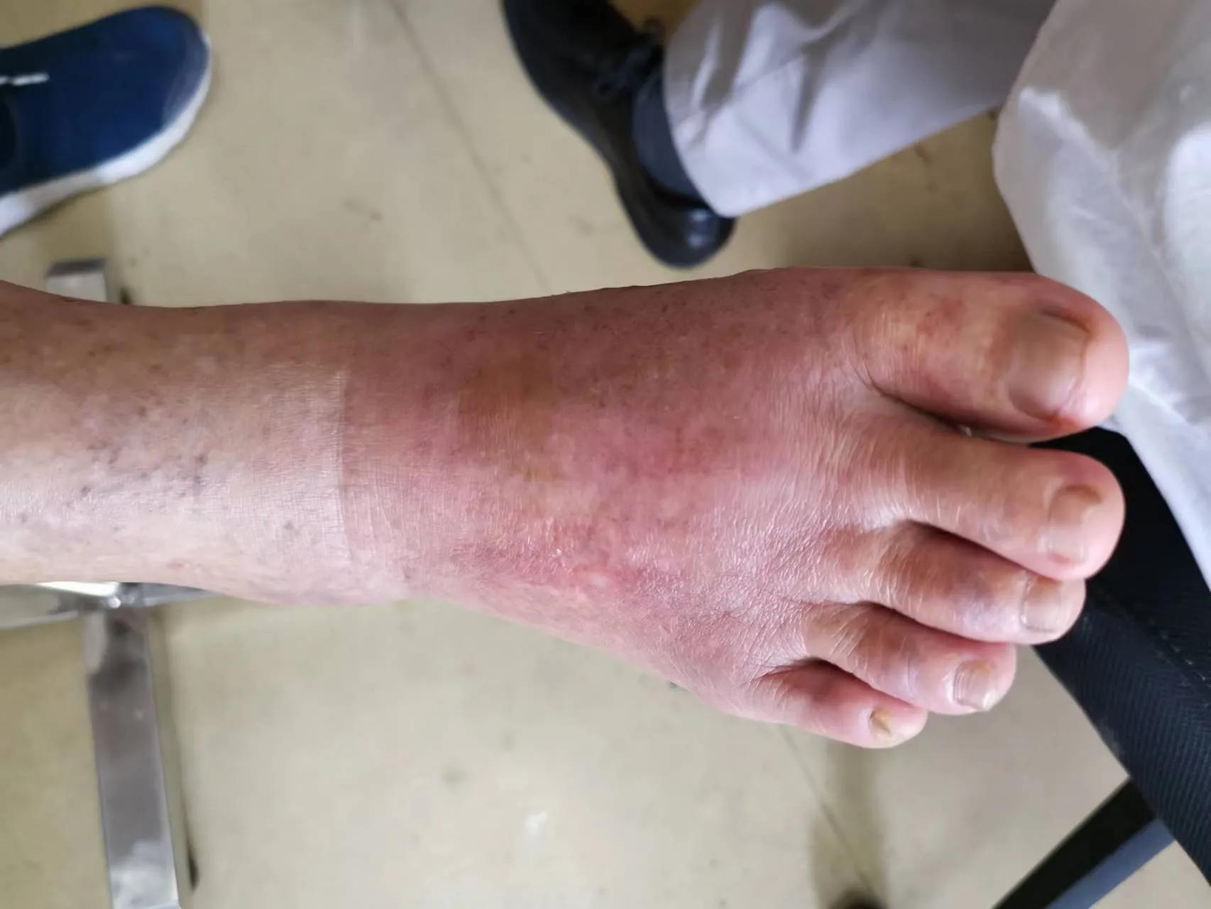 女生教你脚踝扭伤处理方法,脚踝扭伤一年后还疼怎么处理