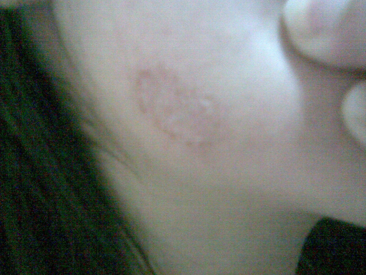 癣和皮炎最明显的区别用药一样吗,癣和皮炎怎么分辨