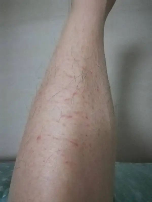 身上老是洗不干净是怎么回事,洗完澡皮肤干痒起白皮屑怎么回事