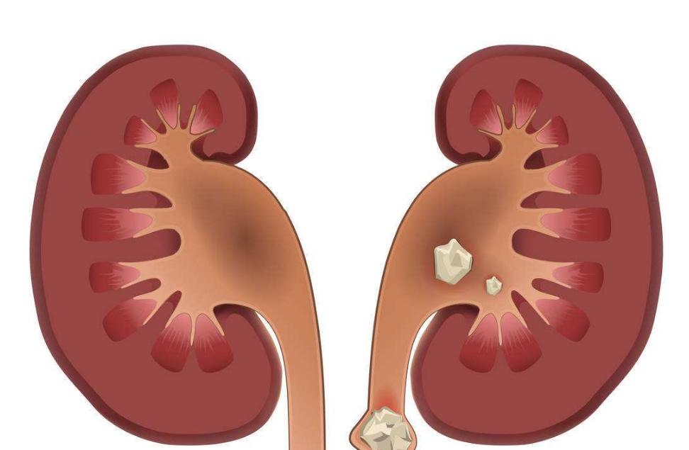 肾结石是什么病，治疗不及时会发生什么？术后护理需要注意些什么