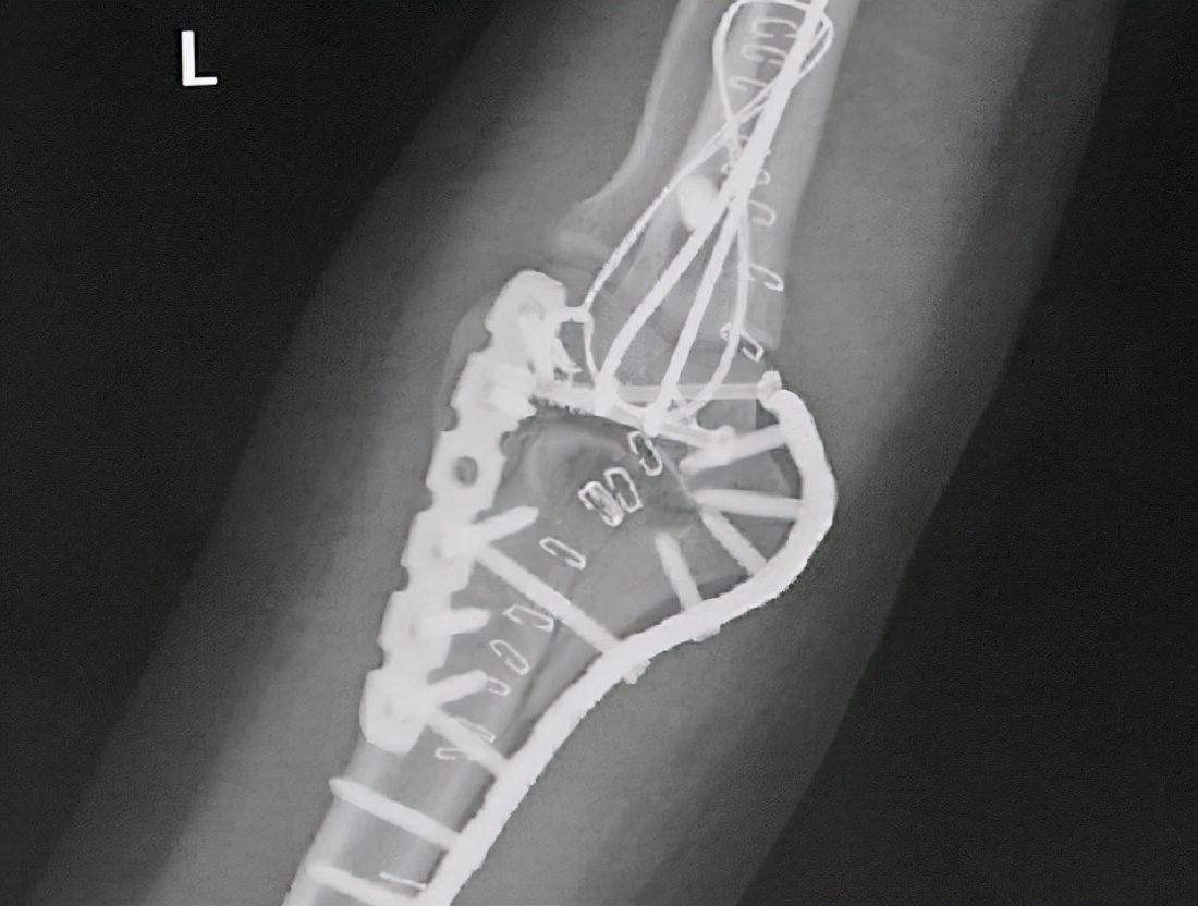 肘关节骨折手术需要多少钱,肘关节骨折治疗方法