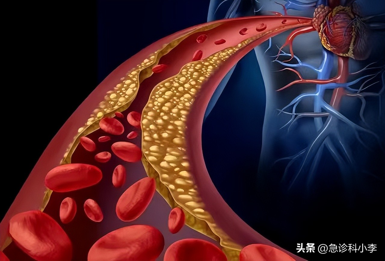 降压药伟哥,3种降压药组合降不下来血压