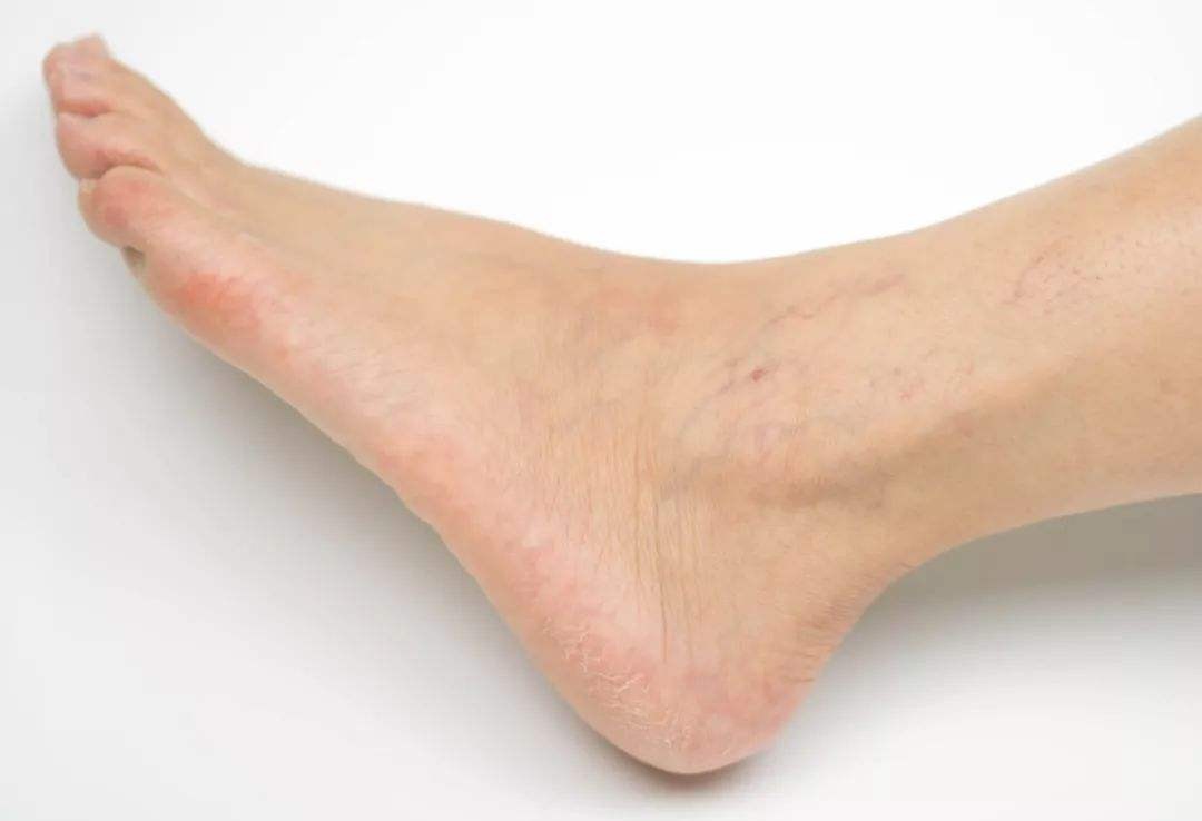 缓解静脉曲张简单实用不花冤枉钱,精索静脉曲张吃药能缓解疼痛吗