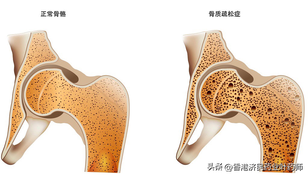 骨质疏松症为什么需要抑制骨吸收,使骨折风险性增加的药物