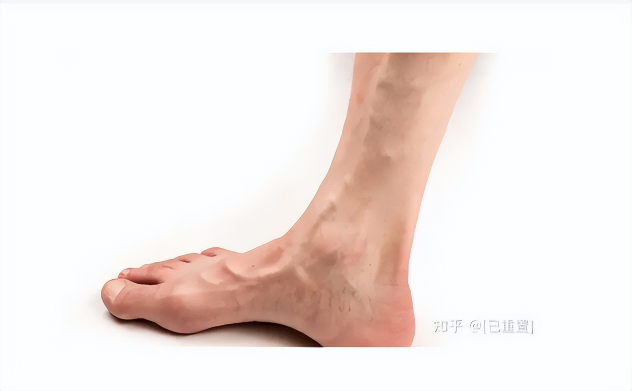 北京医院血管外科李鹏：下肢静脉曲张，如何治疗？