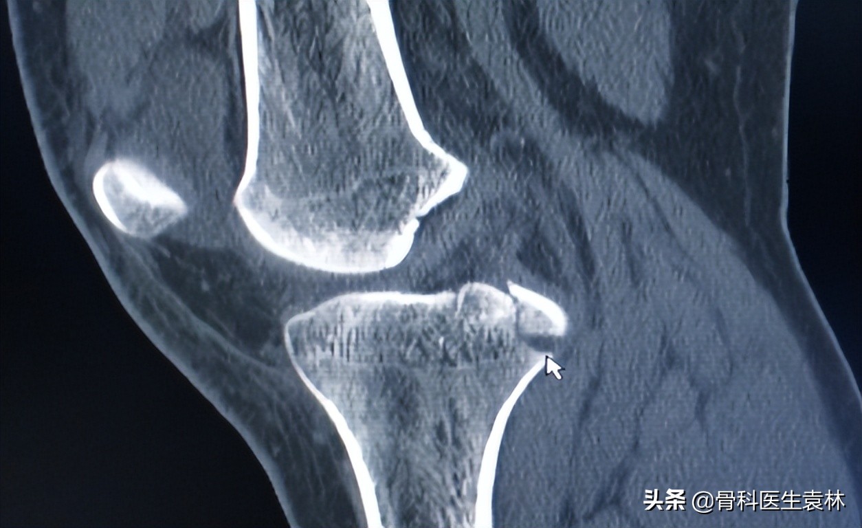 什么是关节软骨？关节软骨退化应该怎么治疗？