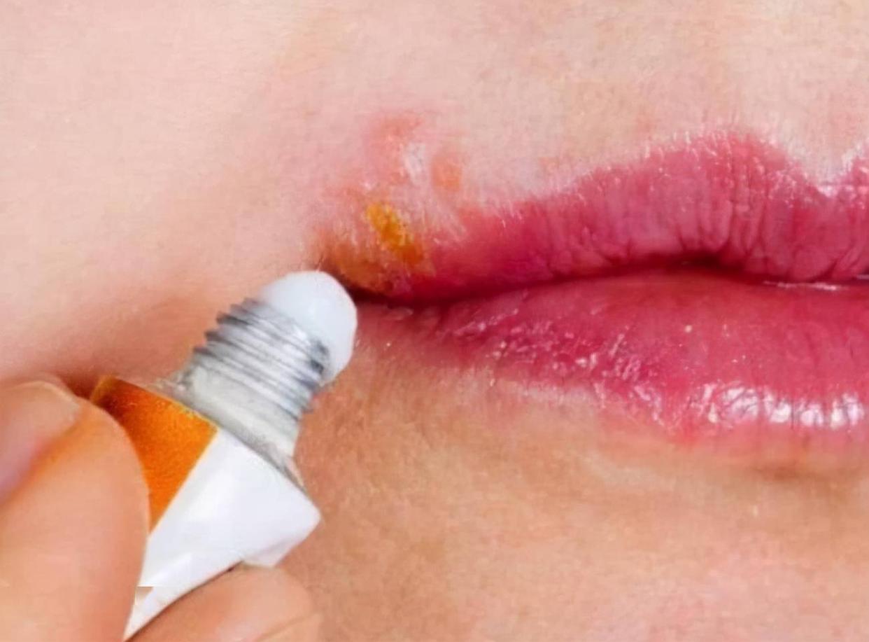 2块钱的红霉素软膏,红霉素软膏滥用