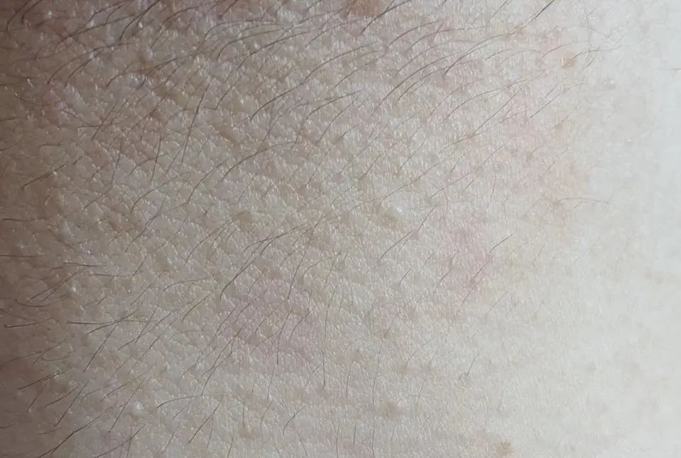 换季会出现的小痘痘,长红疙瘩像痘痘如何消除