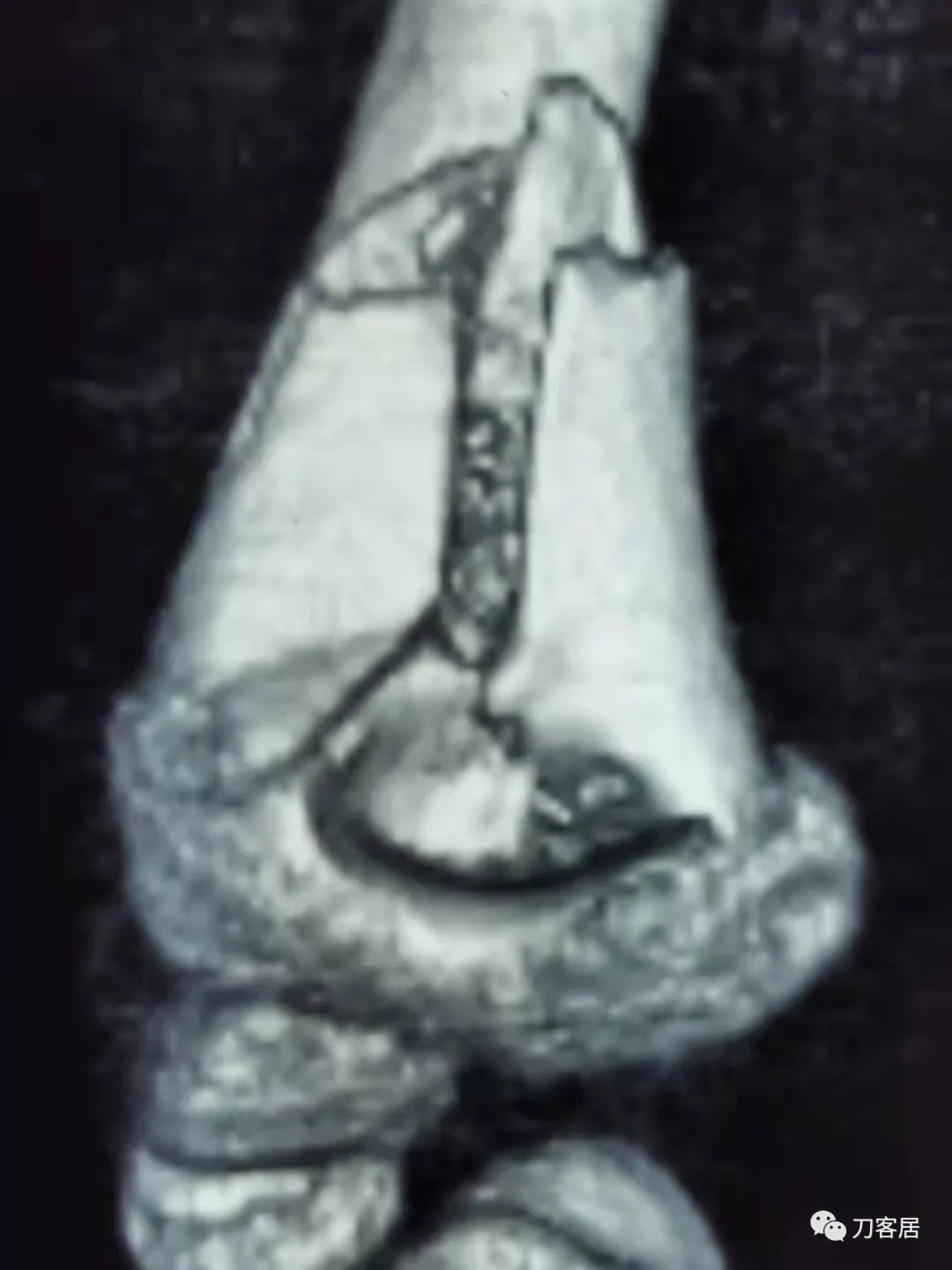 孩子胳膊摔伤肿了不能弯曲一直疼,9岁男孩摔倒手臂痛怎么办