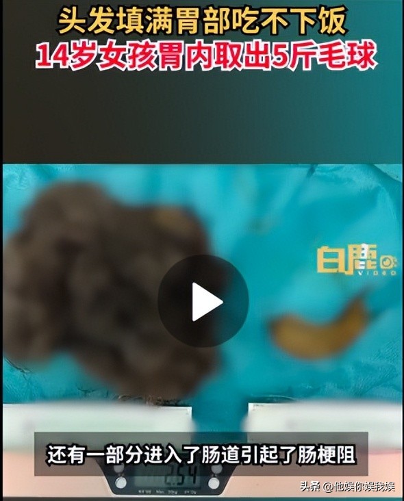 心疼西安这位14岁留守女孩，吃自己头发让胃积满5斤毛球