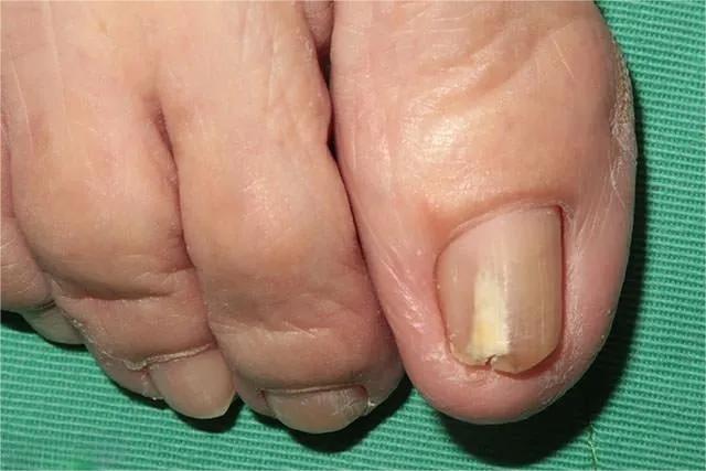 甲癣不严重怎么治疗,甲易生治疗灰指甲吗