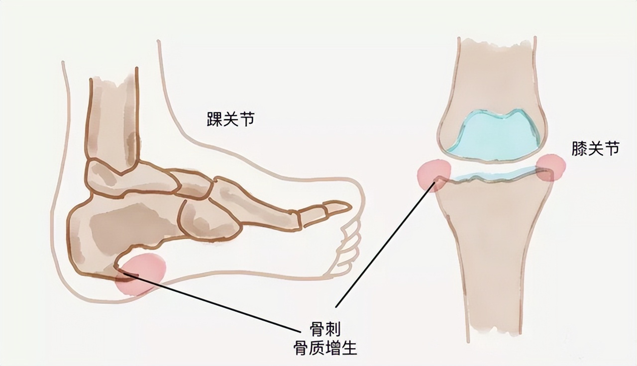 什么叫做骨刺骨刺都长在什么地方,什么是骨刺能根治吗