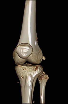 韧带断裂微创手术能恢复正常吗,打篮球韧带断裂做手术多少钱