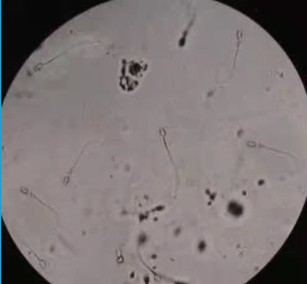 前列腺常规检查报告单正常,前列腺核磁共振报告单怎么解读