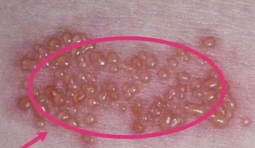 蛇盘疮越长越多怎么办,蛇盘疮腰缠一圈真的会要人命吗