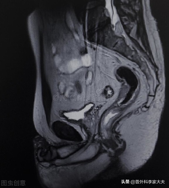 直肠癌的新辅助放疗技术,直肠癌医生建议先化疗再手术