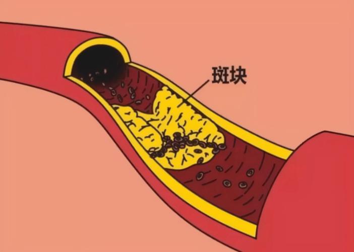 猪油是营养品还是心血管杀手,一勺猪油等于五副药