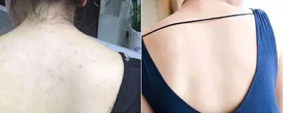 家庭祛除螨虫的有效方法是什么,家里有螨虫用什么东西除螨好