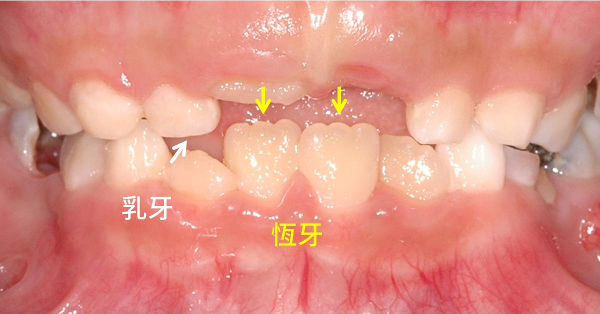 孩子换的新牙畸形牙怎么办,小孩换牙齿出来的好丑怎么办