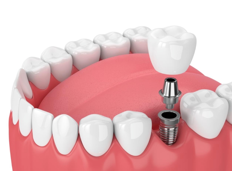 牙齿意外松动最佳补救方法,牙齿意外碎裂怎么处理