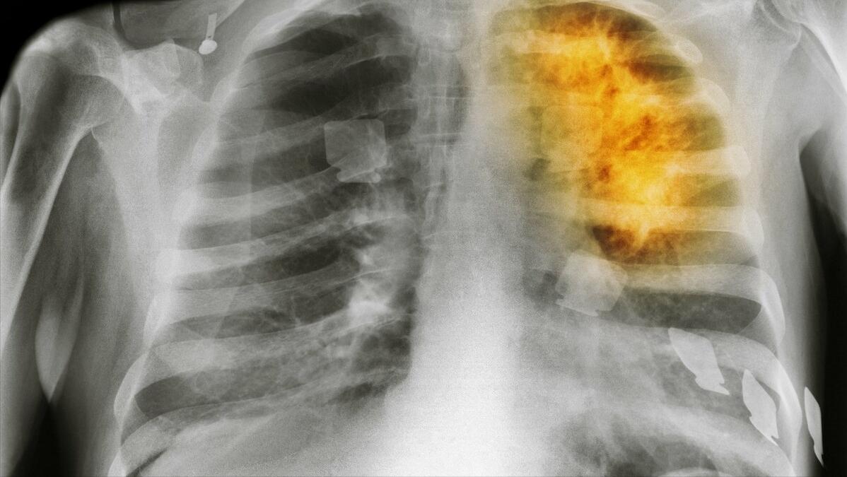 老年人弯腰驼背怎么治,老人弯腰驼背怎么回事