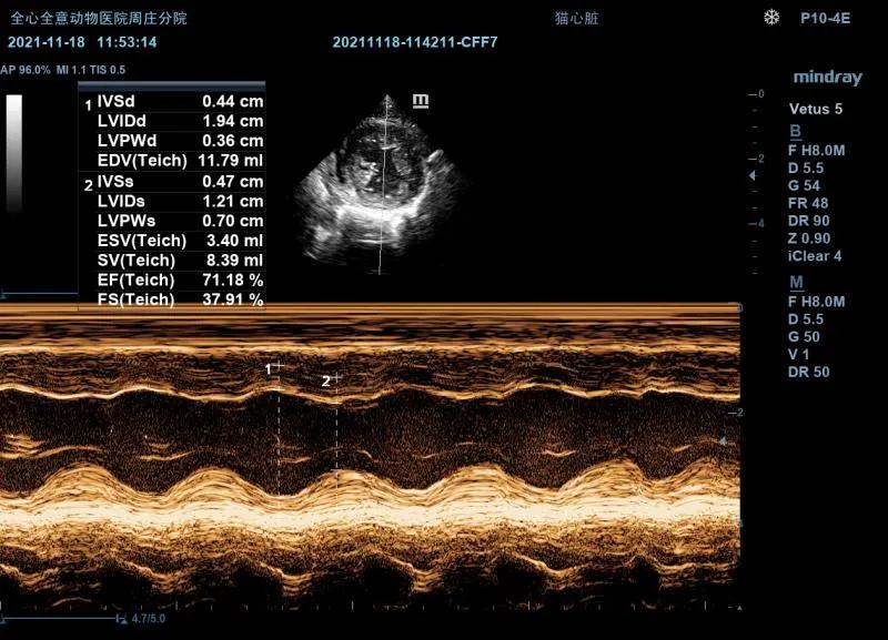 二尖瓣发育不良病例总结