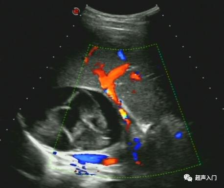 肝包虫病B超能检查出来吗?