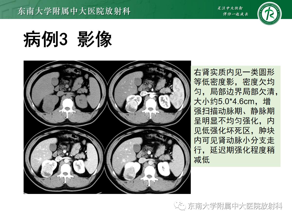 周利群谈肾嫌色细胞癌ct特点,好文分享值得深思