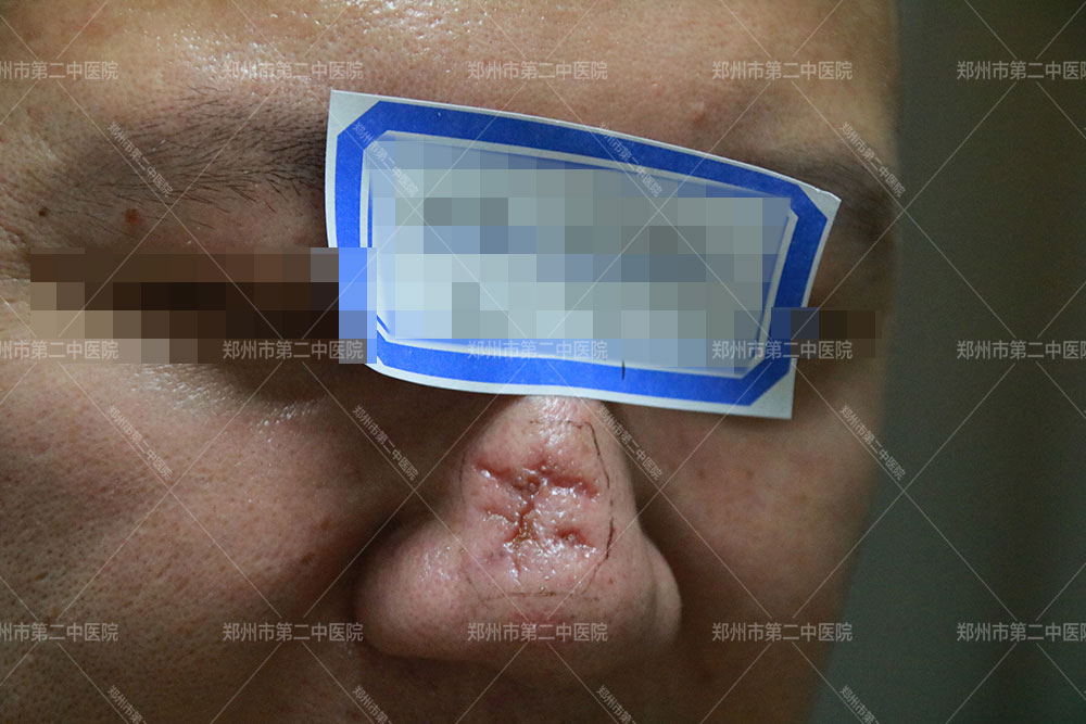 河南中医院疤痕治疗靠谱吗,县医院治疗疤痕