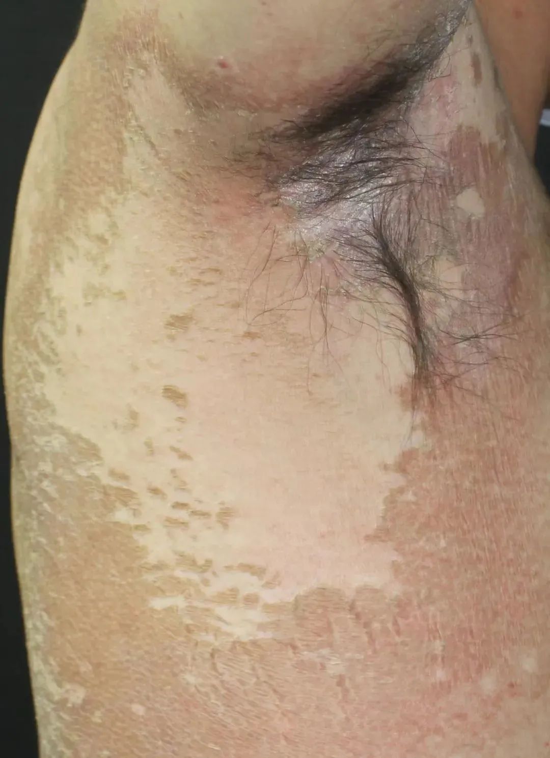 皮肤可以用的洗衣消毒液,洗衣液用的太多会导致皮痒吗