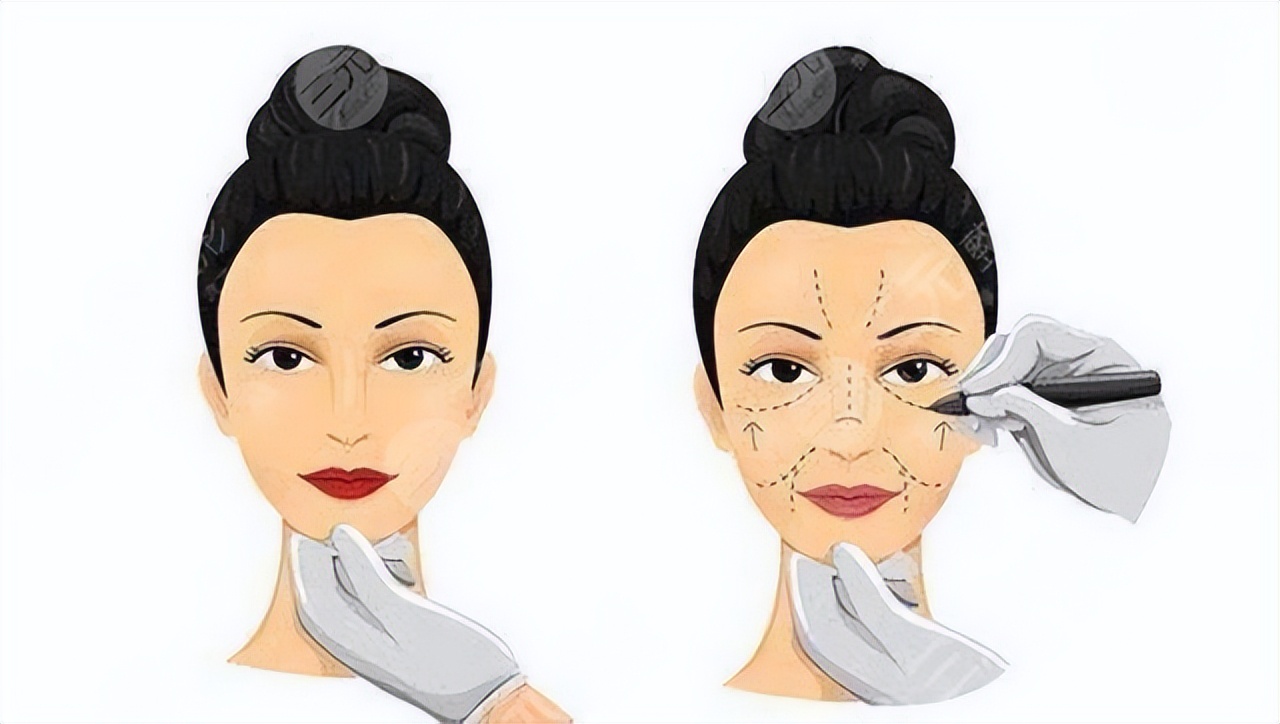 千万别做拉皮手术后遗症太可怕了,拉皮手术会有什么后遗症吗